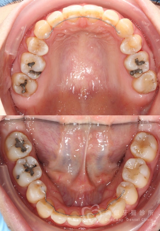 暴牙嘟嘴案例一