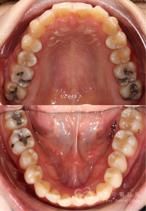 暴牙嘟嘴案例一