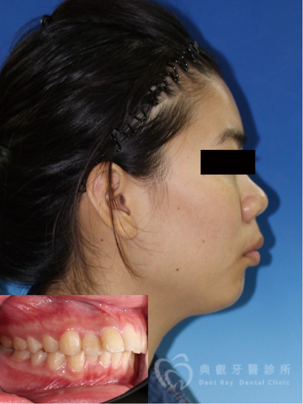 暴牙嘟嘴案例二