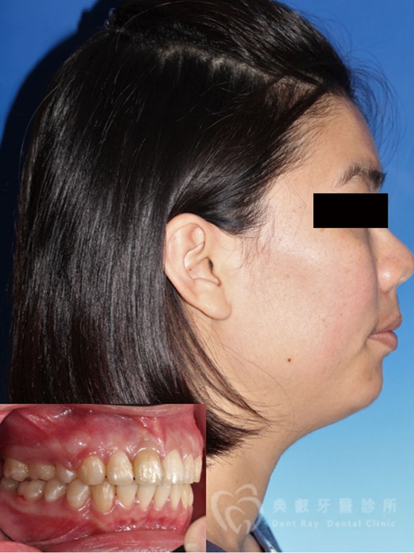 暴牙嘟嘴案例二