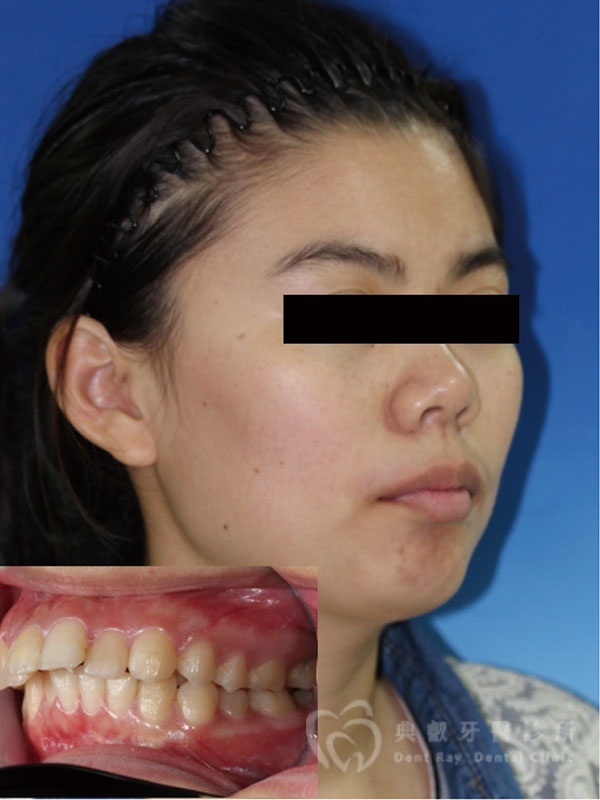 暴牙嘟嘴案例二