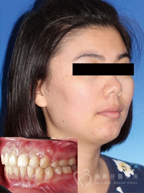 暴牙嘟嘴案例二