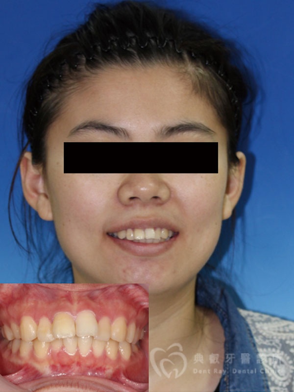 暴牙嘟嘴案例二