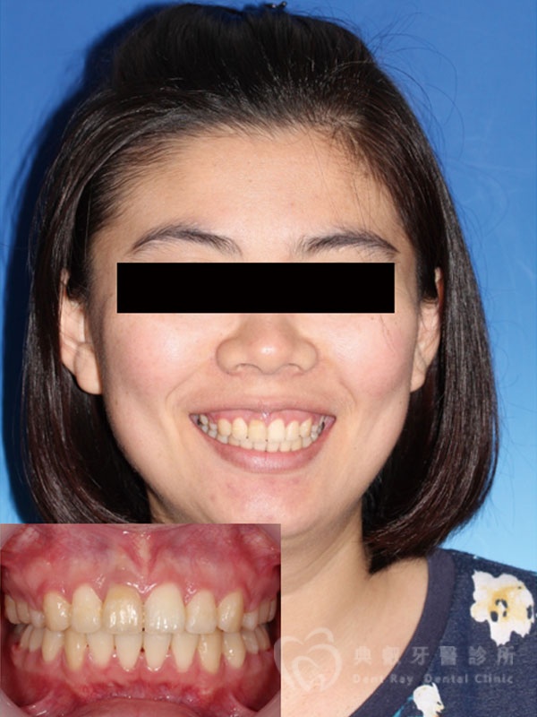 暴牙嘟嘴案例二