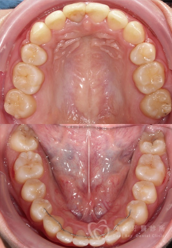 暴牙嘟嘴案例二