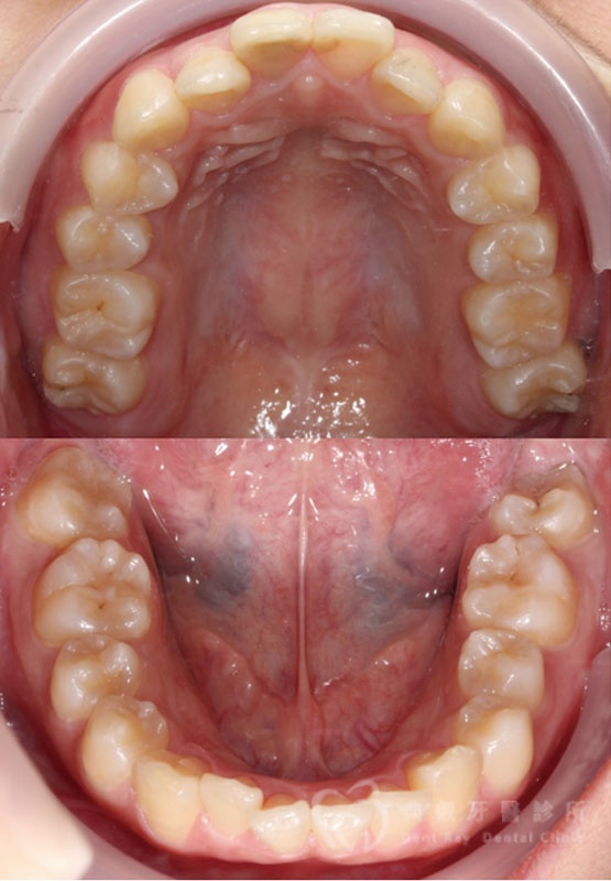 暴牙嘟嘴案例二