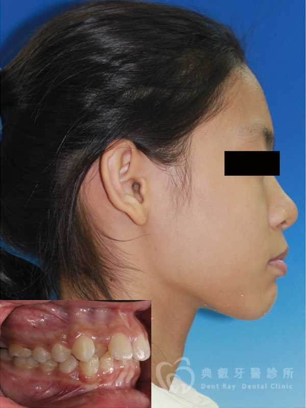 錯咬釘狀齒案例