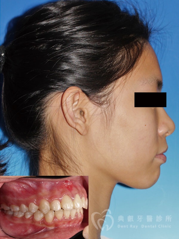 錯咬釘狀齒案例