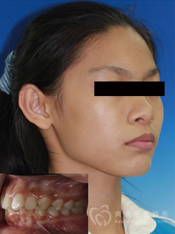 錯咬釘狀齒案例