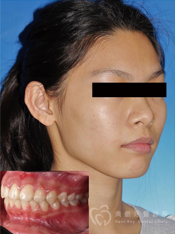 錯咬釘狀齒案例