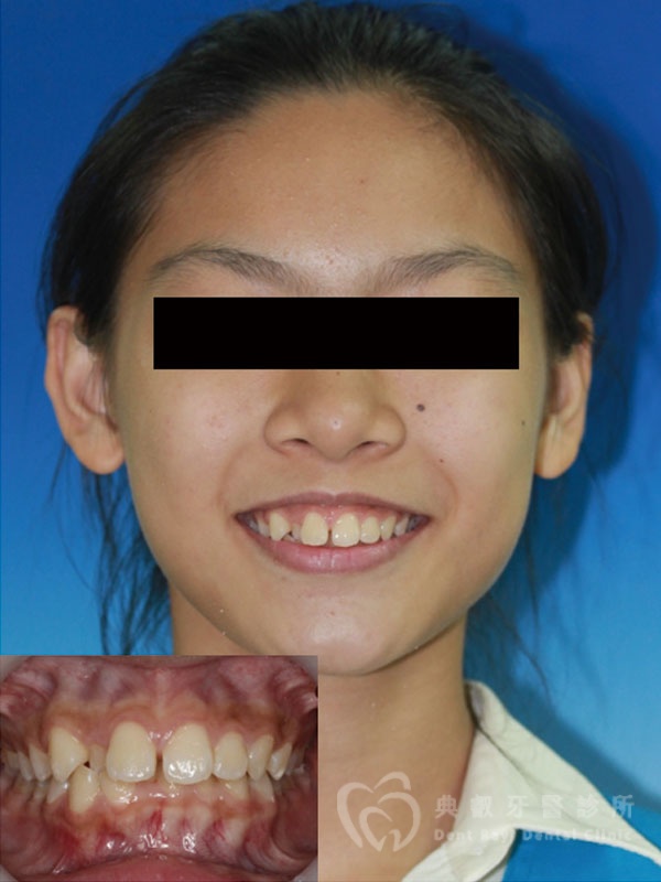 錯咬釘狀齒案例