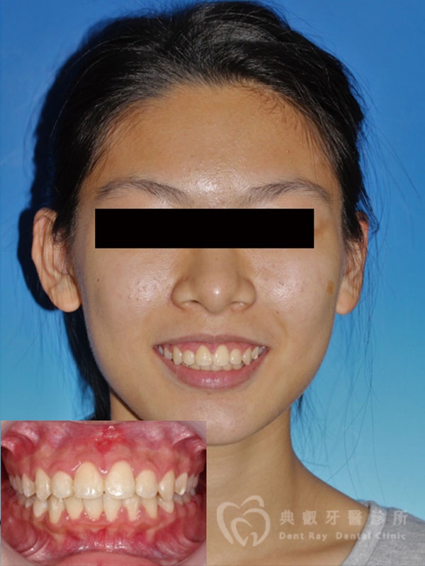 錯咬釘狀齒案例