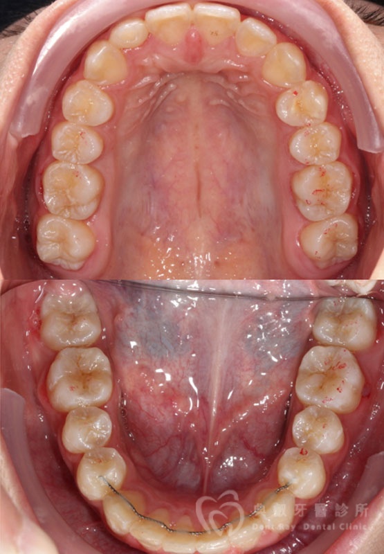 錯咬釘狀齒案例