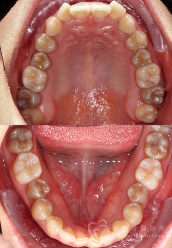 隱形矯正案例