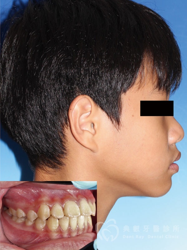 兒童早期矯正案例
