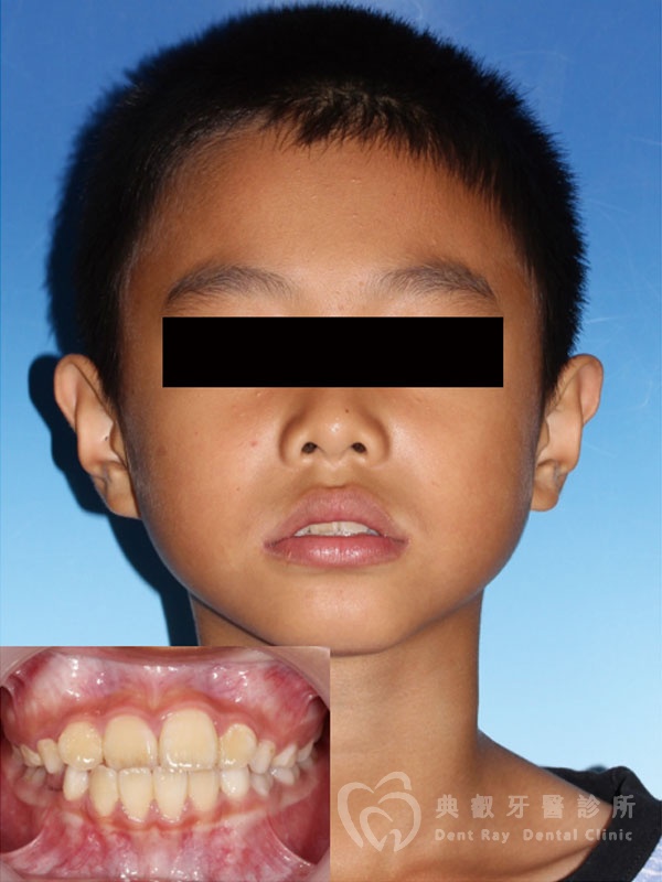 兒童早期矯正案例