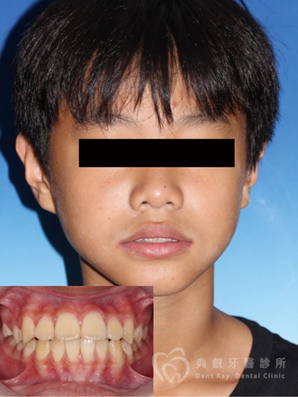 兒童早期矯正案例