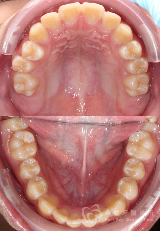 兒童早期矯正案例