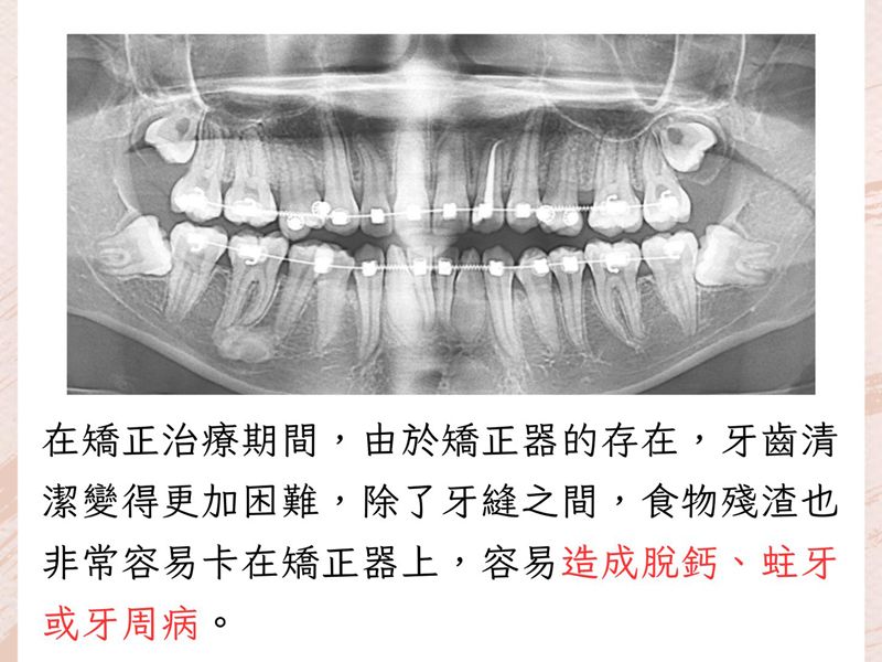 🦷 戴矯正器，刷牙要更仔細！