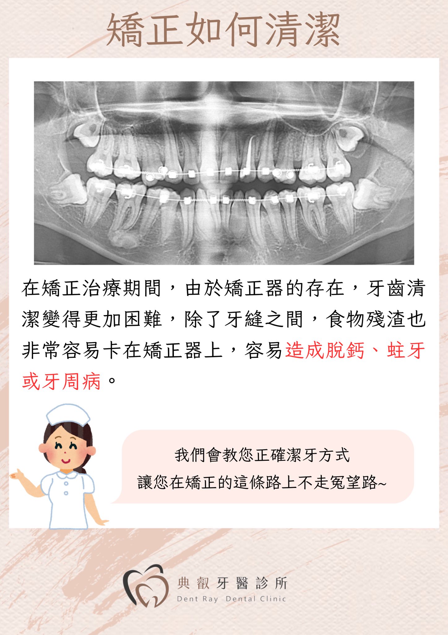 🦷 戴矯正器，刷牙要更仔細！