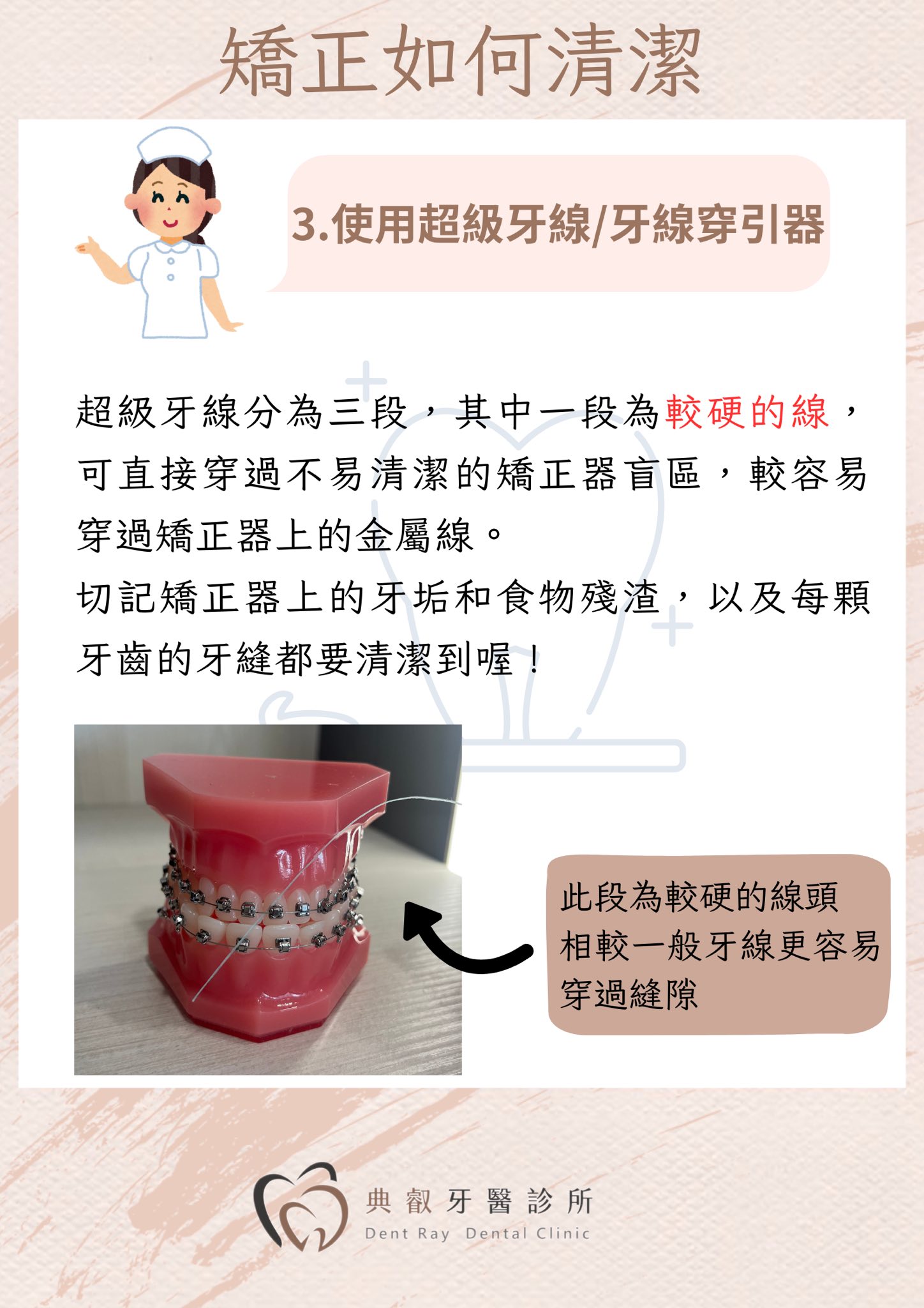 🦷 戴矯正器，刷牙要更仔細！