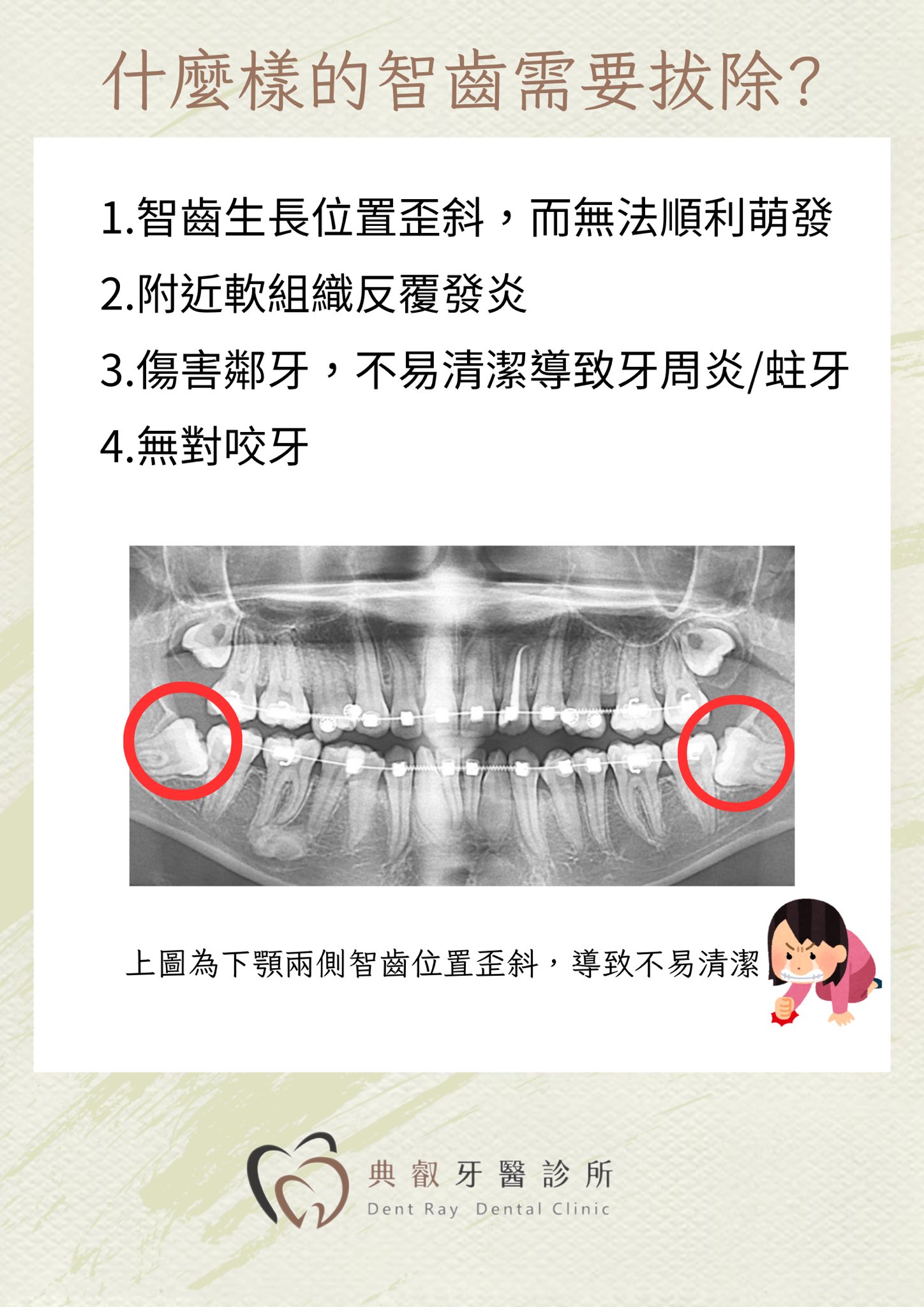 什麼樣的智齒需要拔除？🤔