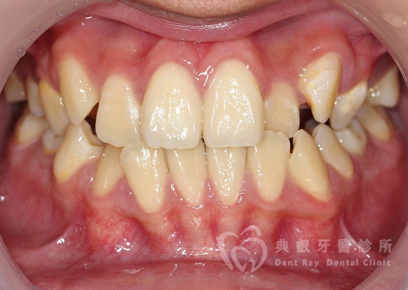 排列擁擠案例一