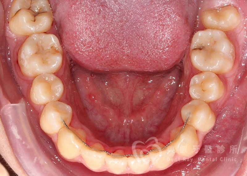 排列擁擠案例一