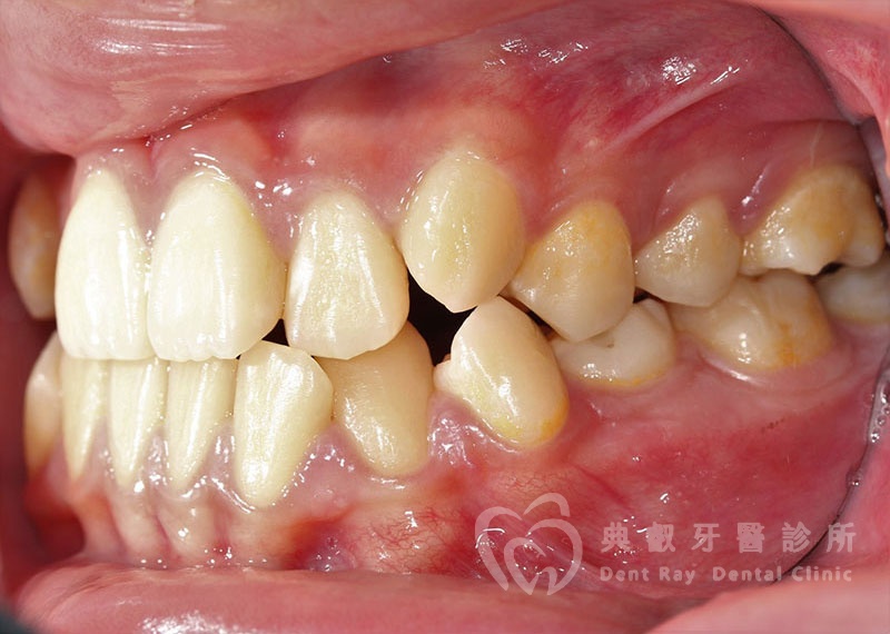 排列擁擠案例一