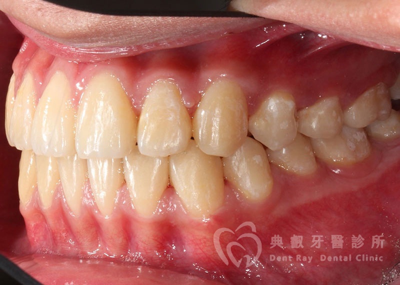 排列擁擠案例一