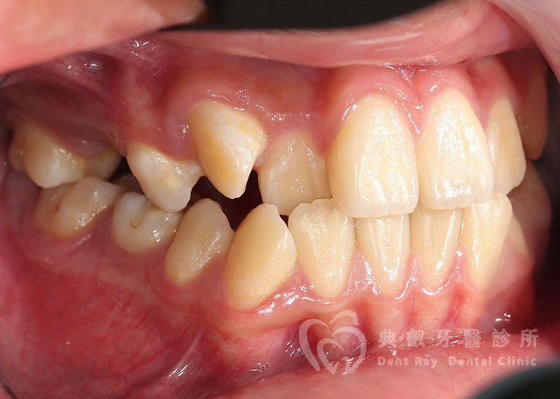 排列擁擠案例一