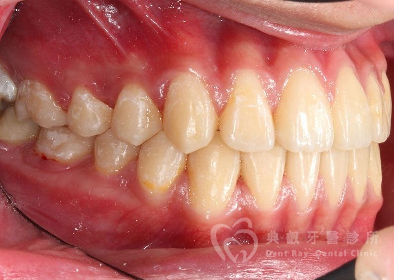 排列擁擠案例一