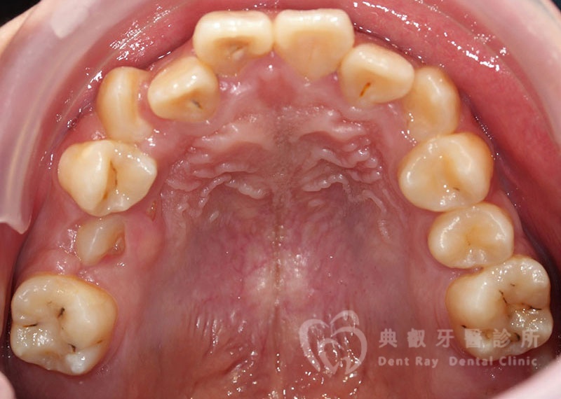 排列擁擠案例一