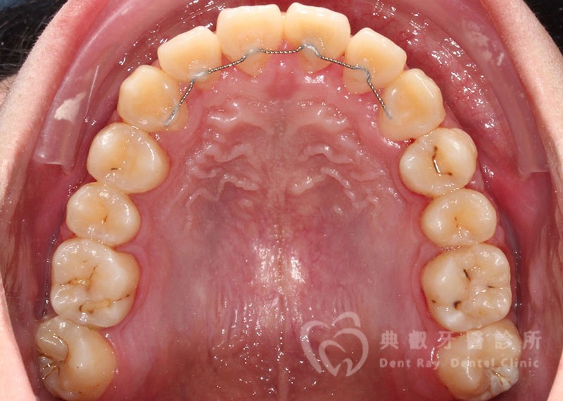 排列擁擠案例一