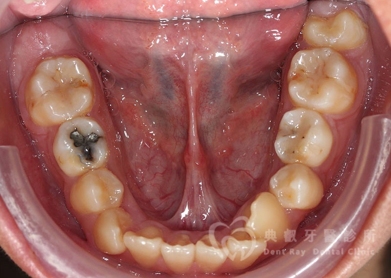 排列擁擠案例一