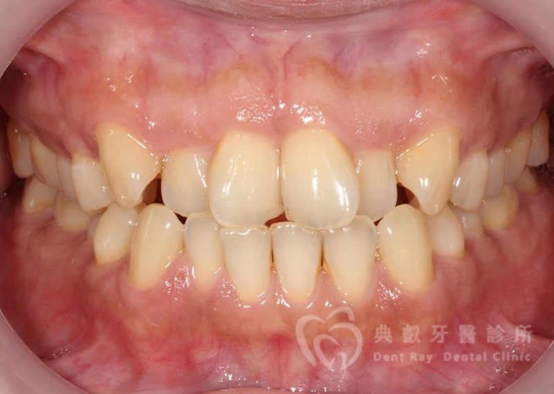 排列擁擠案例二