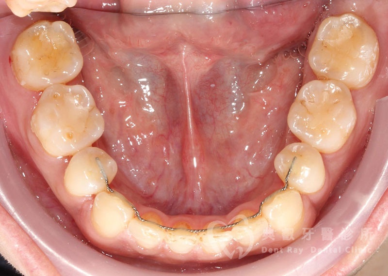 排列擁擠案例二