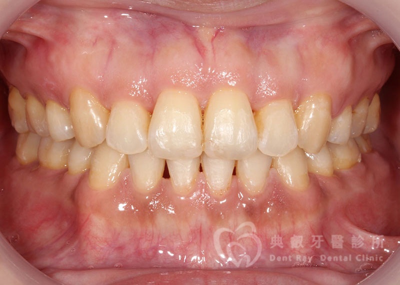 排列擁擠案例二