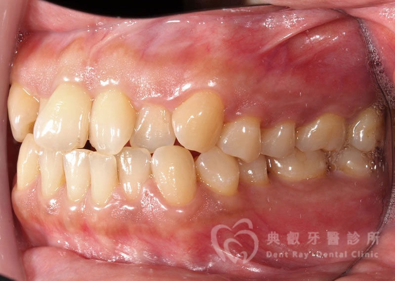 排列擁擠案例二