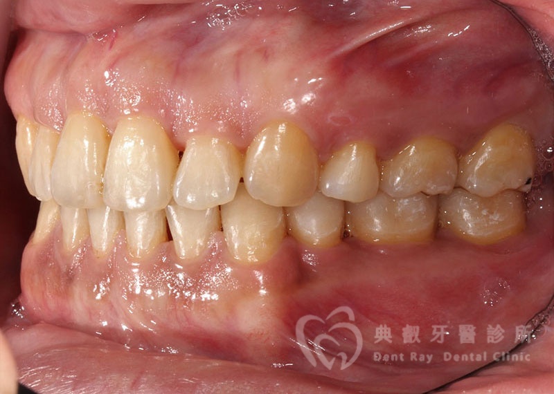 排列擁擠案例二