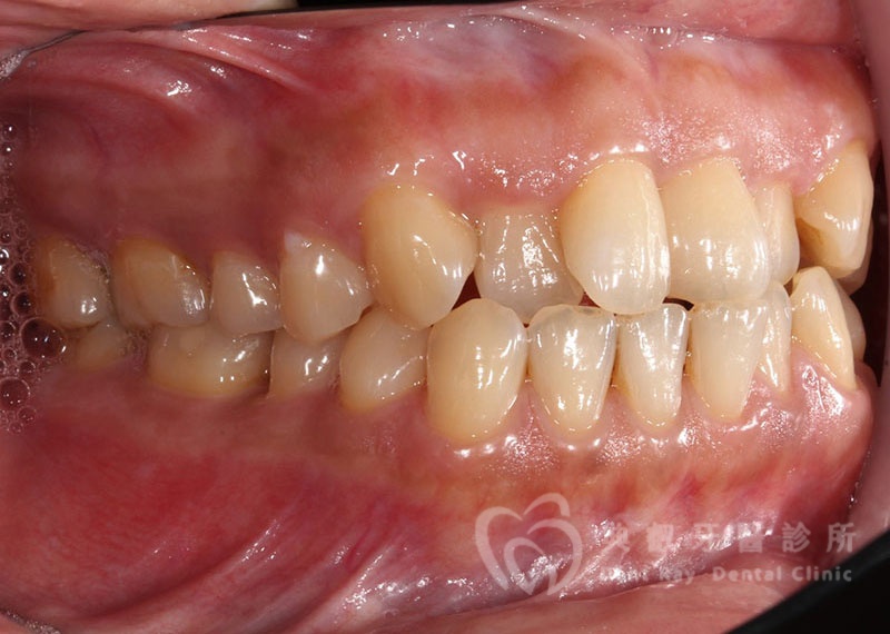 排列擁擠案例二