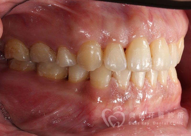 排列擁擠案例二