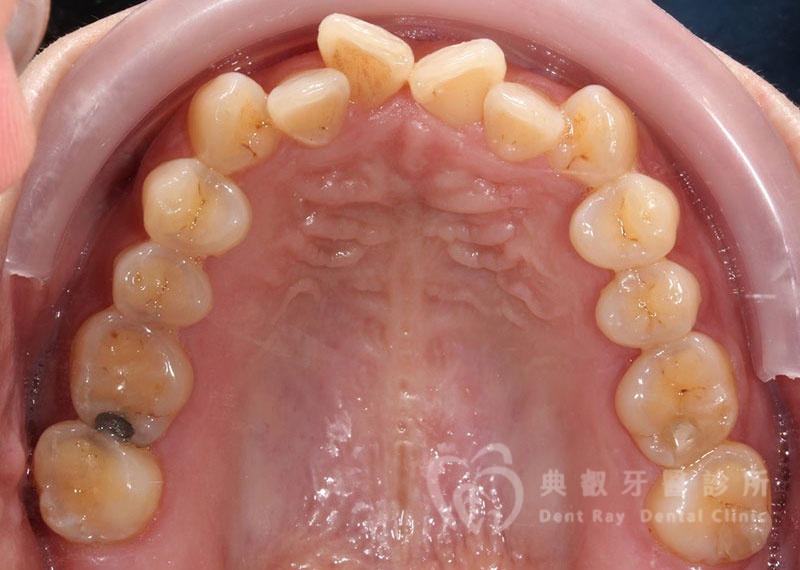 排列擁擠案例二