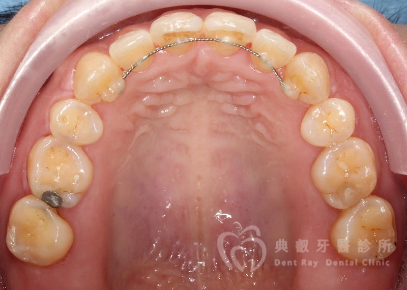 排列擁擠案例二