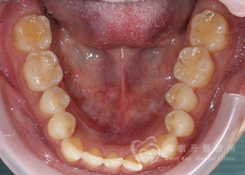 排列擁擠案例二